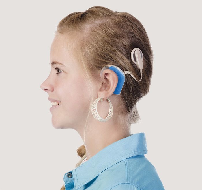cochlea implantat Frau