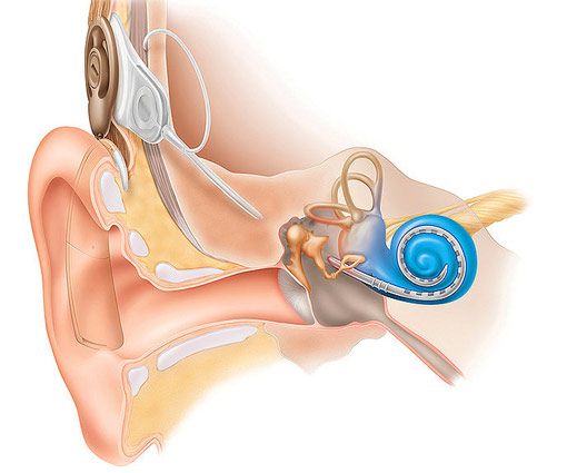 Hörhilfe Aufbau Implantat
