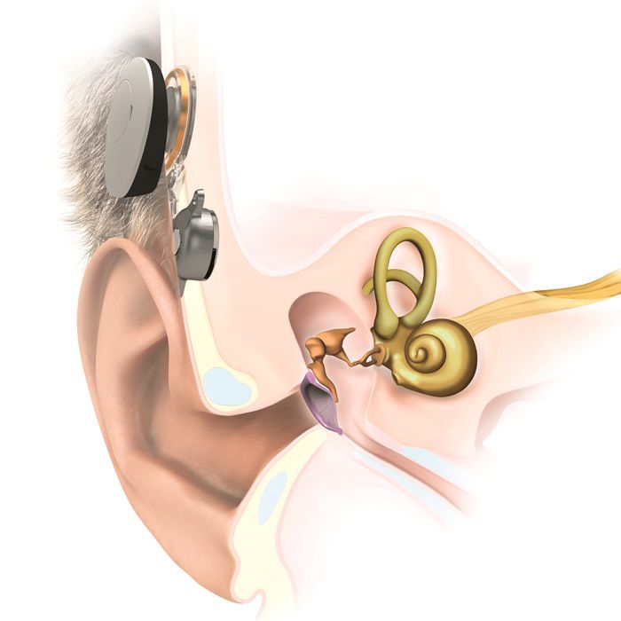Hörgerät bei Schallleitungsschwerhörigkeit