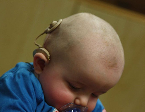 Kinder Hörhilfe implantat