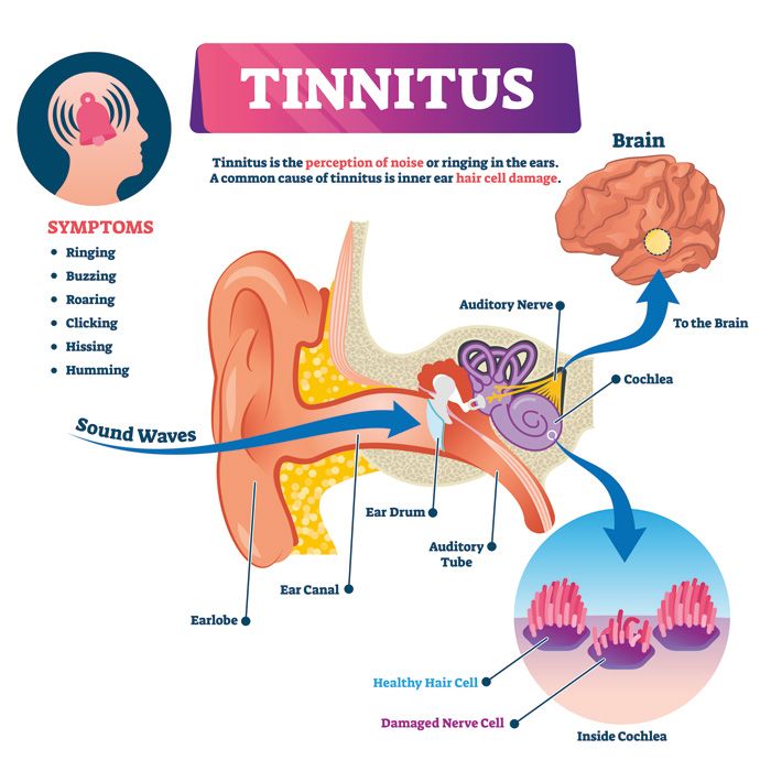 Tinnitus Illustration Grafik