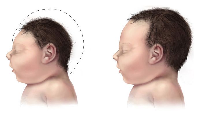 Zika-Virus Babys