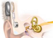 Knochenverankerte Hörgeräte von Oticon Medical 