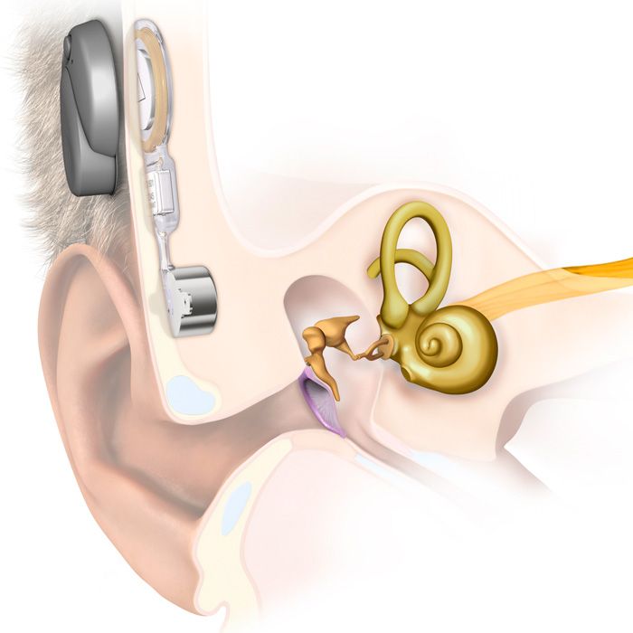 Knochenverankertes Hörgerät