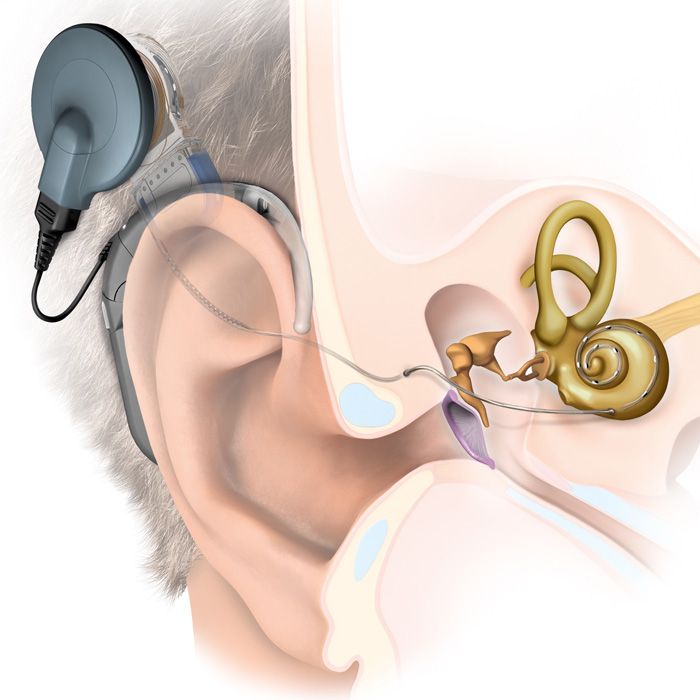 Cochlea Implantat Illustration
