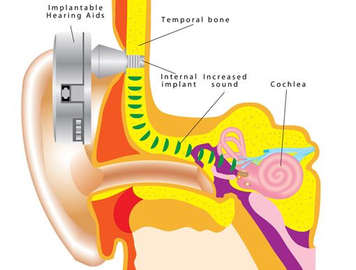 cochlea implantat grafik
