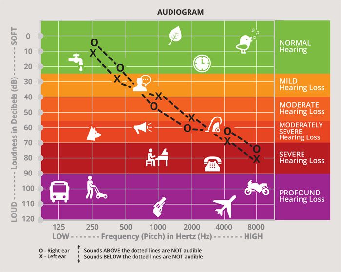 Audiogramm