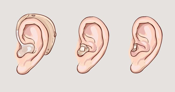 Hörgeräte Arten