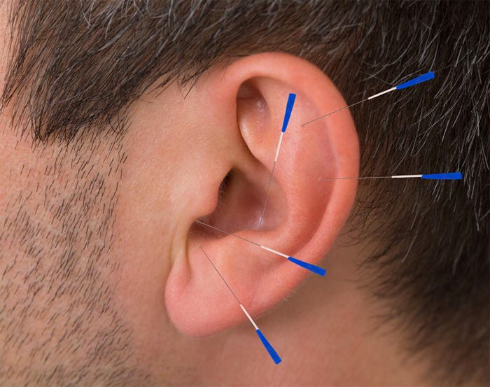 Hörverlust Akupunktur
