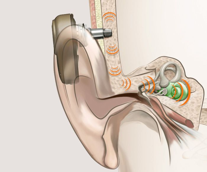 Knochenverankerte Hörsysteme